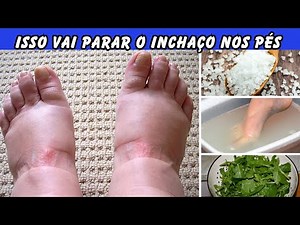 PÉS INCHADOS causas e tratamentos de inchaço nos pés e pernas