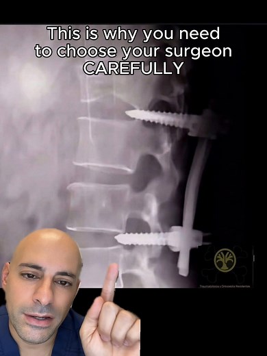 A botched surgery like this can change your life forever. It is essential that you know, trust, and believe your surgeon will do what's best for you. Be safe out there guys. #doctor #botched #surgery ✅Follow @drdavidabbasi for More Daily Medical Content & Health Tips! 🌴😷Schedule a consultation to see Dr. Abbasi as a patient in Delray Beach! Visit www.primeorthocenter.com