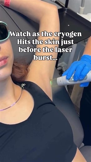 Why do so many practices choose Candela’s GentleMax Pro® and GentleMax Pro® Plus for laser hair removal? There are plenty of reasons — but one standout feature is our unique DCD™ cooling system. Just milliseconds before each laser pulse, a fine mist of cryogen is delivered to the skin. This protects the epidermis and significantly enhances patient comfort, allowing for effective treatment without compromising on experience. Not all laser platforms offer this level of integrated cooling technolog