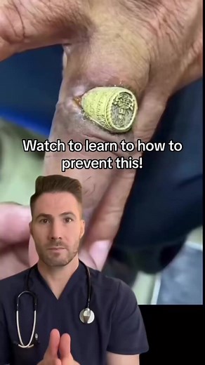 7.5K views · 60 reactions | string method is a common technique used to remove a ring stuck on a finger. It involves taking a thin, non-elast #reels #reelsfb | Jonh Andrew | Facebook