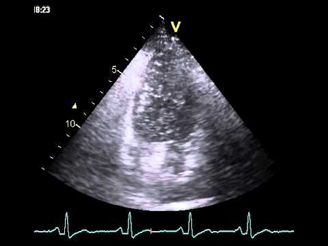 Patent formamen ovale (PFO) with severe right-left shunt