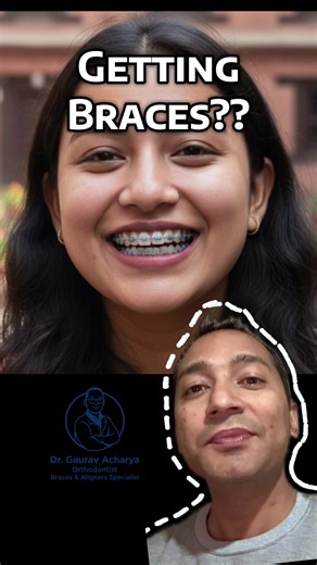 Understanding Braces and Clear Aligners in Nepal