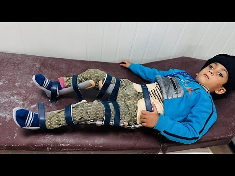 I Provided HKAFO To a Child : HELPING Him To WALK Again | Hip Knee Ankle Foot Orthosis