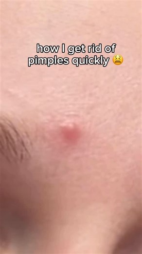 Rachel Finley on Instagram: "How to get rid of an under the skin cystic pimple WITHOUT popping it and giving yourself a big ol scar AKA The MethodTM 💅 #acne #pimple #skincare"