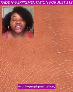 471 reactions · 172 shares | The Best $12 You'll Ever Spend!! Help remove signs of hyperpigmentation, dark spots, acne scars, and sun damage with The Good Molecules Discoloration Correcting Serum. ⚖️ Evens out skin with Niacinamide  Brightens dull and uneven looking skin  Targets signs of discoloration and hyperpigmentation with cetyl tranexamate mesylate | Good Molecules | Facebook