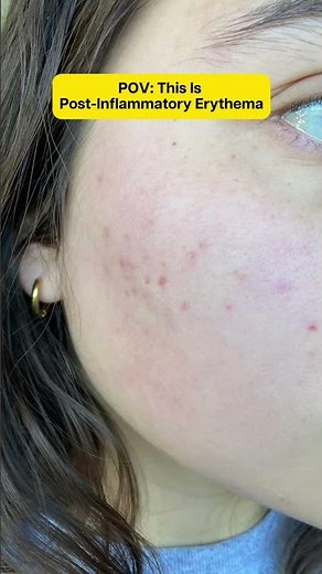Post-Inflammatory Erythema (Red Marks After Acne)