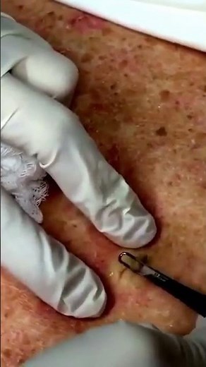 Who's always ready for a good back blackhead extraction? 🙋🏻‍♀️