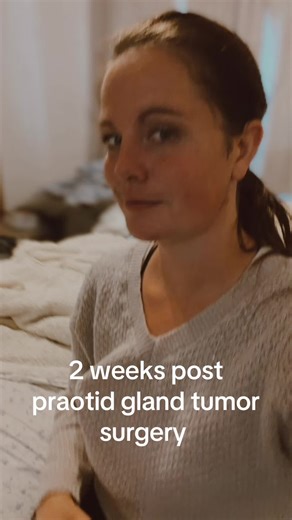 doing pretty good ended up with a small infection that i had to get antibiotics for but on the mend. still sleeping in my chair i think it’s honestly the reason i haven’t had awful swelling! gonna keep sleeping in it another couple weeks. ready to feel 💯 and get back into a normal routine 🤪 #parotidglandtumor #parotidectomy #surgery #mommyof5 #updates