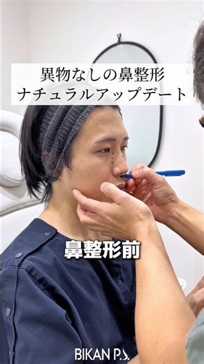 Nose surgery natural update without foreign bodies #nose surgery #beauty #cosmetic surgery #Dr. P...