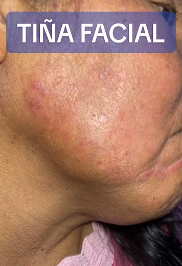 Diagnóstico y tratamiento de la tiña facial