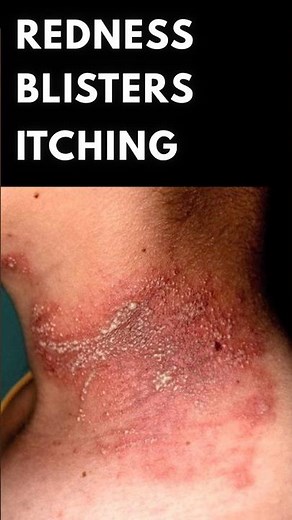 Paederus dermatitis | insect allergy #shorts #insects #dermatitis