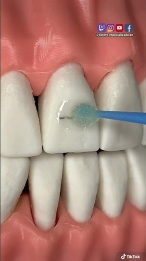 ¡🔥TUTORIAL para instalar brackets estéticos🔥!