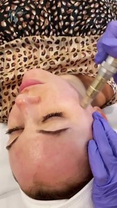 1️⃣Dermaplane ⠀⠀⠀⠀⠀⠀⠀⠀⠀⠀⠀⠀ 2️⃣Lactic Acid Chemical Peel...