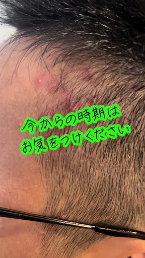 頭皮湿疹対策とケア方法の紹介
