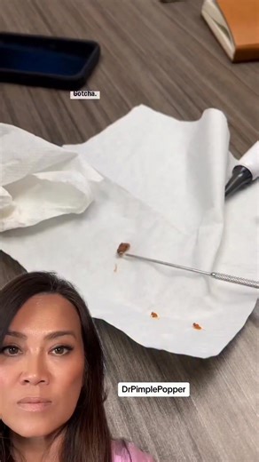 That “earwax” you’re watching being removed? It’s not dirt. It’s a totally normal mix of oil (sebum) dead skin cells, produced by specialized sebaceous glands inside the ear canal. Just like your face, your ears have oil glands. That oil: ✔️ Traps dust and debris ✔️ Protects the delicate ear canal ✔️ Keeps skin from drying out But when oil shed skin build up faster than they clear, you get impaction — and that’s when it needs to be safely removed in a medical setting. Skin is skin, even in your 