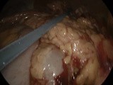 Acute Gangrenous Perforated Appendicitis with General Peretonitis • Video • MEDtube.net