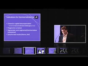 Hemivertebrae Excision for Scoliosis - Advanced Surgery Part One