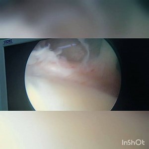Surgery for recurrent shoulder dislocation. Bankart repair done using arthroscopy. | Dr Naveen Sharma's Advance Orthopedic and Sports injury Hospital