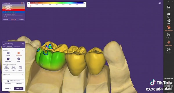 Cómo diseñar un puente dental