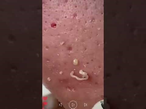 blackhead removal from nose/ old aged blackheads removal