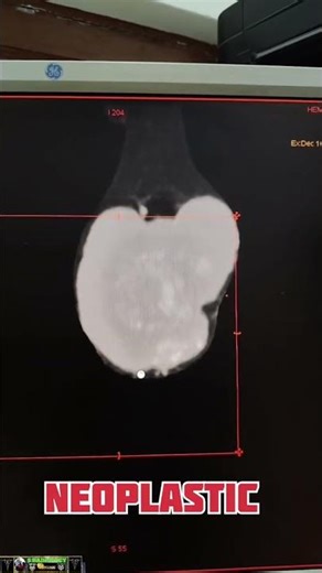 NEOPLASTIC #CT ELBOW