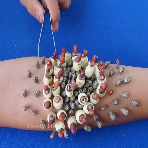 Removing and Picking a Ticks 2475 | Good video 1