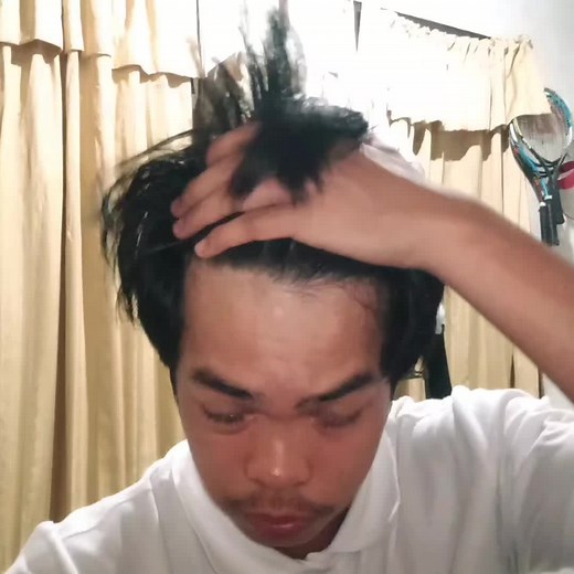 Managing Alopecia Areata Symptoms: Causes, Treatments, and More!