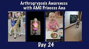487 reactions · 77 shares | DAY 24 - Today Ana talks about how Arthrogryposis can sometimes affect only the upper extremities or sometimes only the lower extremities but the most common is to have all four limbs affected. | Team AMC Ana | Facebook