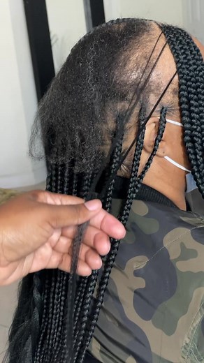 Cover-Up Braids: Alopecia Friendly Hairstyles for Women