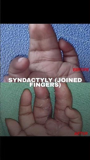 Syndactyly Surgery (Joined Fingers) | Restoring Hand Function