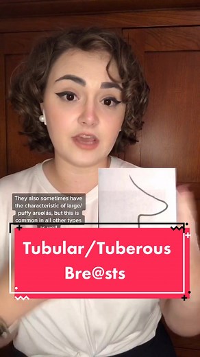 Understanding Tubular/Tuberous Bre@sts