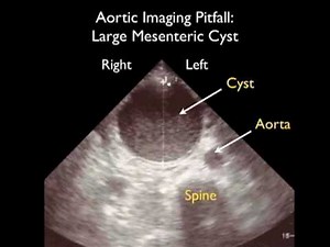 How To: Aorta Ultrasound - Aneurysms Case Study Video