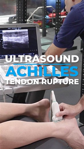 When and how is an ultrasound beneficial in the diagnosis and management of Achilles tendon ruptures? #AchillesRupture #AchillesInjury #AchillesRehab #AchillesRecovery #TendonInjury #TendonRehab #SoftTissueInjury | The Sports MAP Network