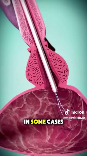 Understanding Enlarged Prostate with 3D Animation