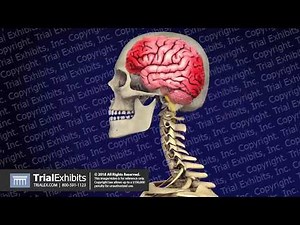 Coup Contracoup Injury