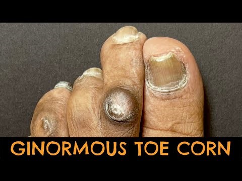 SHAVING OF A GINORMOUS PAINFUL CORN !!!