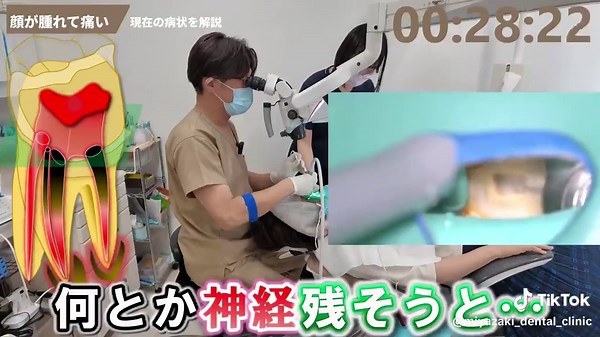 顔腫れ、ズキズキ歯が痛む！セラミック治療後になぜ？#宮崎歯科医院 #根管治療