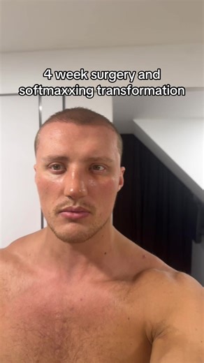 4 week surgery and softmaxxing transformation