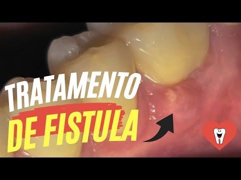 COMO RESOLVER UMA FÍSTULA ASSOCIADA AO CANAL DO DENTE? - Endolovers