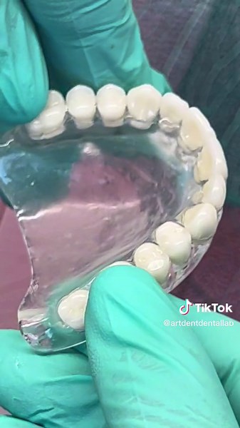 Clear Dentures…Vertex Thermosens♨️… #artdent_dental_laboratory #dentallab #dentaltechnician #dentures #softdenture #completedenture #completedentalcare #fulldenture #dentist #dentistry #dentistryworld #dentistrylove #lovemyjob♥️ #handmade