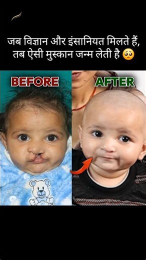 Cleft Lip Patient Surgery by Dr. Satya Saraswat at Saraswat Hospital Agra, India