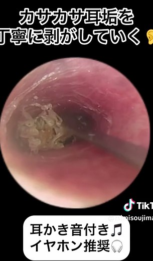 耳掃除動画とカサカサ耳垢の除去方法
