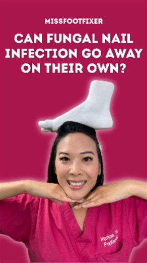 10K views · 27 reactions | Can fungal nail go away on its own? 樂 Short answer: No! But it can be treated effectively with the right approach.  Learn what actually works to get your nails healthy again   Visit our website for more info : https://www.footcliniclondon.co.uk/ #missfootfixer #educationalcontent #podiatrist #fungalnailtreatment #podiatricmedicine | Miss Foot Fixer | Facebook