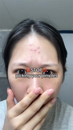 Mung Bean Clay Mask: Your Solution for Acne-Prone Skin