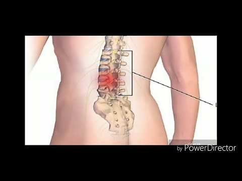 कमर की नस दबने का रामबाण ilaj || dabi hui naso ka ilaj