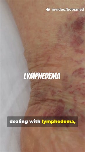 Lymphedema Explained in 60 Seconds! 🦵🩺