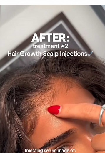 Scalp Injections 🌟 Using stem cells & nutrients to stimulate thicker/fuller hair & growth -> 2-4 sessions recommended, 1 month apart 💲 Pricing: $160 for injections only, $200 for full hair treatment 📍 Located in North Hollywood, Los Angeles, CA 📩 Schedule an appointment online, website linked in bio #scalpinjections #hairgrowthinjection #hairgrowthtreatment #scalptreatment #scalptreatmeants #stemcelltherapy