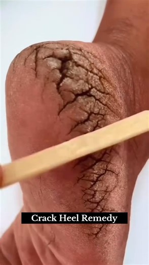 ✅ Best Home Remedies For Cracked Heels #shorts #heels