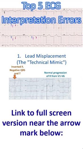 Top 5 ECG Interpretation Errors