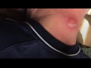 ASMR : pop a giant boil on back, pimple & cyst popping this week, blackheads, zits and acne treatmen